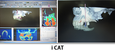 CTを診断ソフトで診断した画像 iCAT
