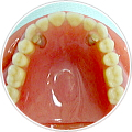 義歯（入れ歯）　磁性アタッチメント