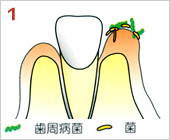 歯周病の進行の仕方01