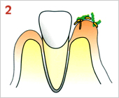 歯周病の進行の仕方02