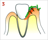 歯周病の進行の仕方03